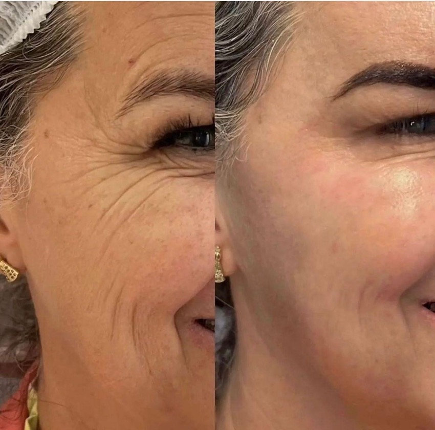 Comparación visual del aspecto de la piel alrededor de los ojos